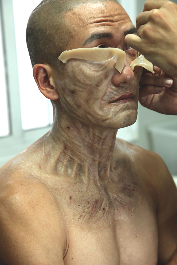 Aplicación de prótesis facial para Paraíso